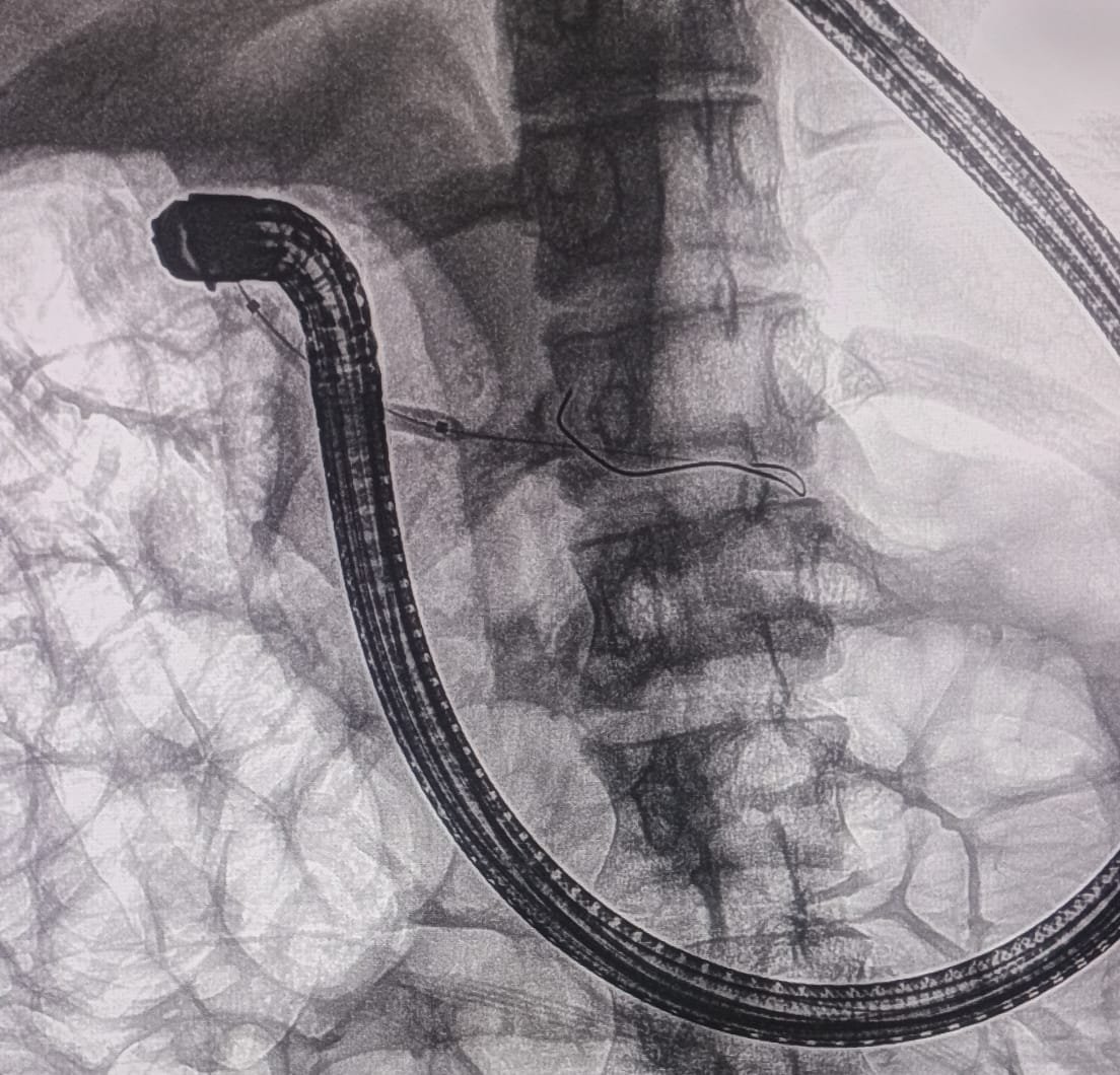 Chronic Pancreatitis ERCP Image 4